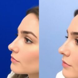 Orr-hegymodellő injekciók: Az egyszerű és hatékony alternatíva a rinoplasztikához