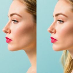 Állkontúr-plasztika – Szögletes vagy kerekebb forma? Milyen forma illik hozzád igazán?