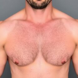 Férfi mellkassebészet titkai: Hogyan kezelik a ginekomastiát?