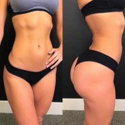 Emsculpt: Az izomépítés és zsírégetés új dimenziója a has, fenék és comb formálásában