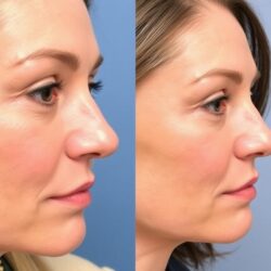 Szemkörnyék-fiatalítás: Melyik módszer valóban hozza a kívánt eredményt – töltések, lézer vagy sebészet?